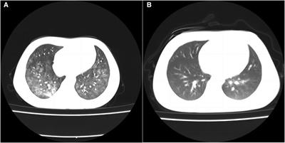 Successful treatment of diffuse alveolar hemorrhage secondary to Mycoplasma pneumoniae complicated with hemophagocytic lymphohistiocytosis in children: a case report and non-systematic literature review
